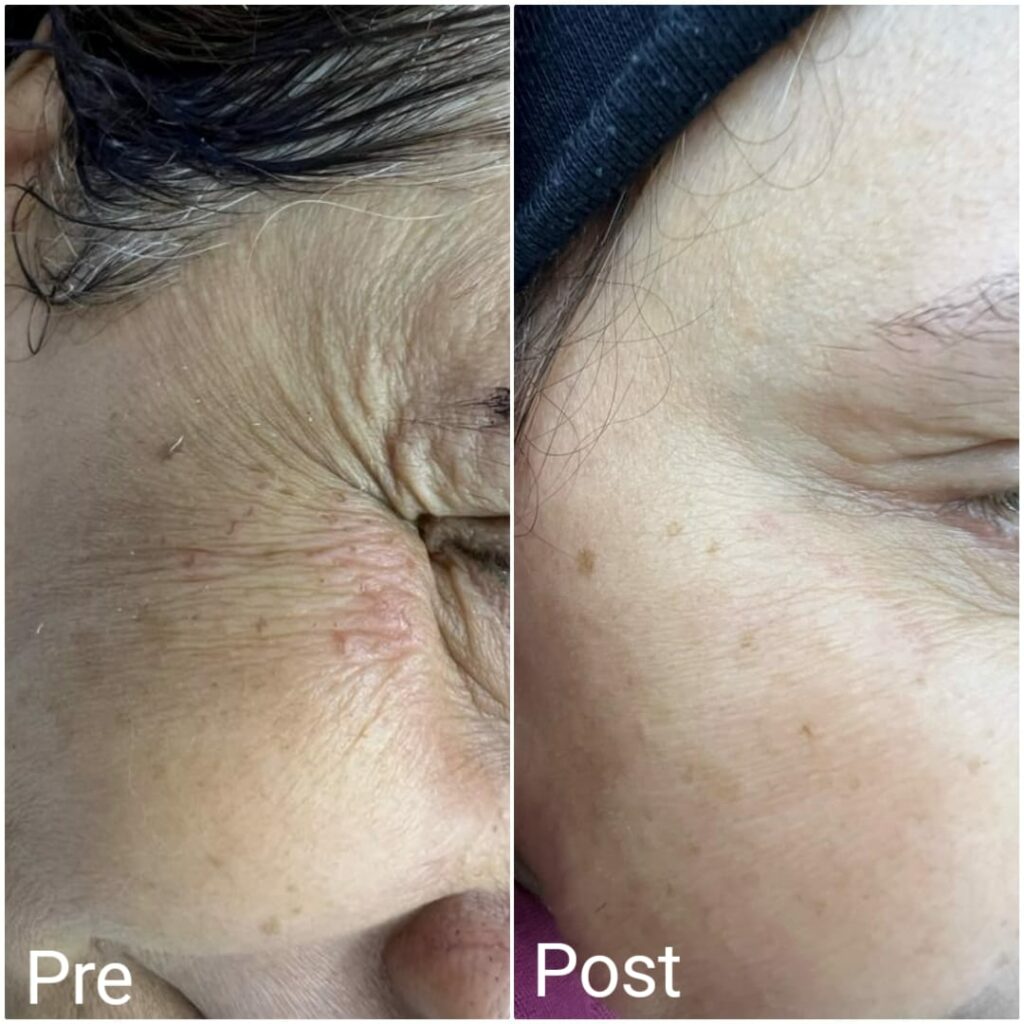 Treating eye wrinkles with Botox